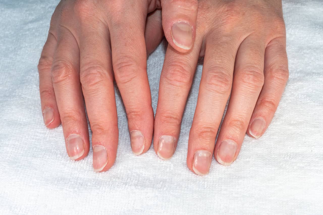 Large Lunulae Or Halfmoons At Fingernails With Longitudinal Lines Of  Southeast Asian Young Man Isolated On White Stock Photo - Download Image  Now - iStock